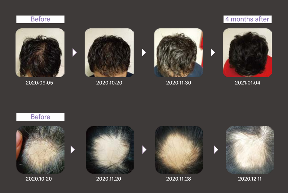 hairna exosomes efficacy hair loss effect hair filler alopecia
