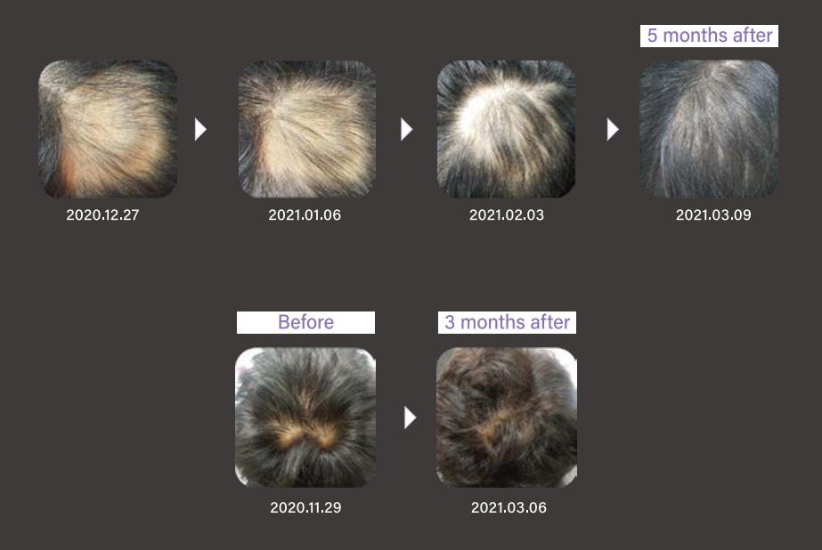 hairna exosomes efficacy hair loss effect hair filler alopecia